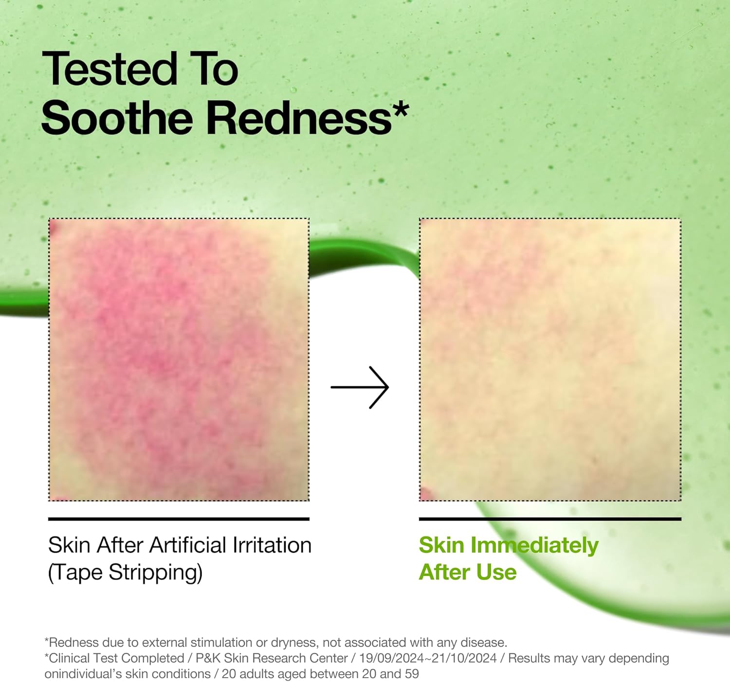 Anua Azelaic Acid 10 Hyaluron Redness Soothing Serum, (30ml/ 1.01 fl oz.)